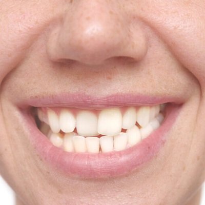 Crowded Teeth Treatment in Dubai & Abu Dhabi Dental Clinic Dubai