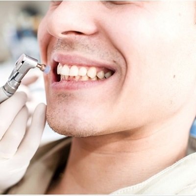Best Deep Scaling And Polishing In Dubai Dental Clinic UAE