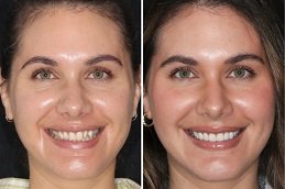 Veneers Dubai