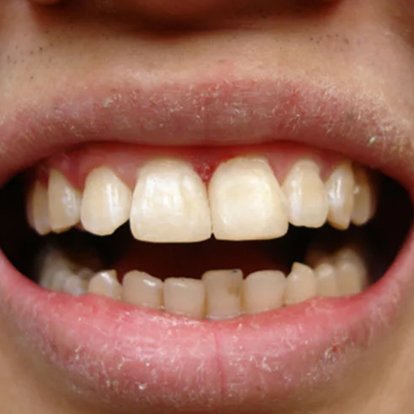 Dental Implants