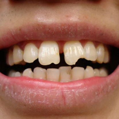 Dental Implants