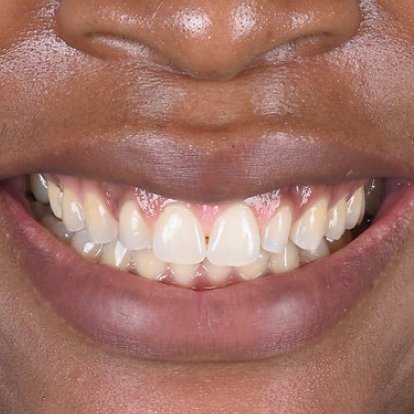 Gum Depigmentaion