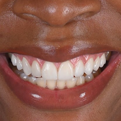 Gum Depigmentaion
