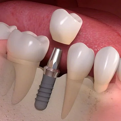 3 Types of Dental Implants and Which One is Best for You