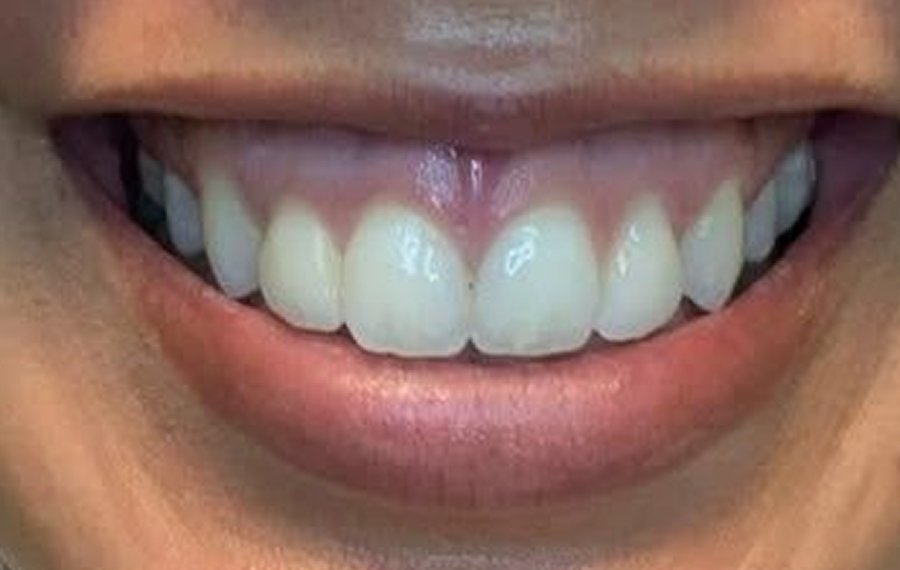 BEst Composite Veneers BEst Composite Veneers