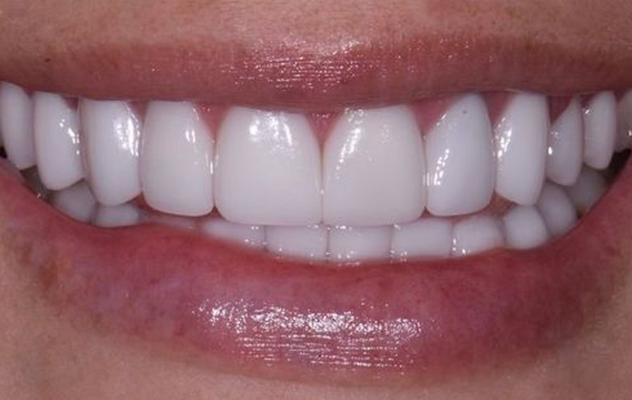 BEst Lithium Disilicate Veneers in Dubai