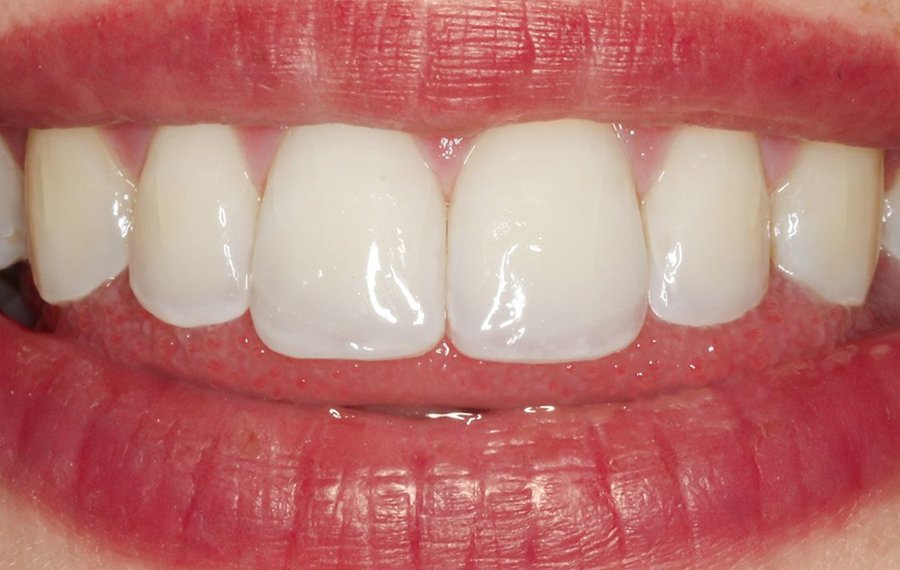 Best Posterior Root Canal Dubai