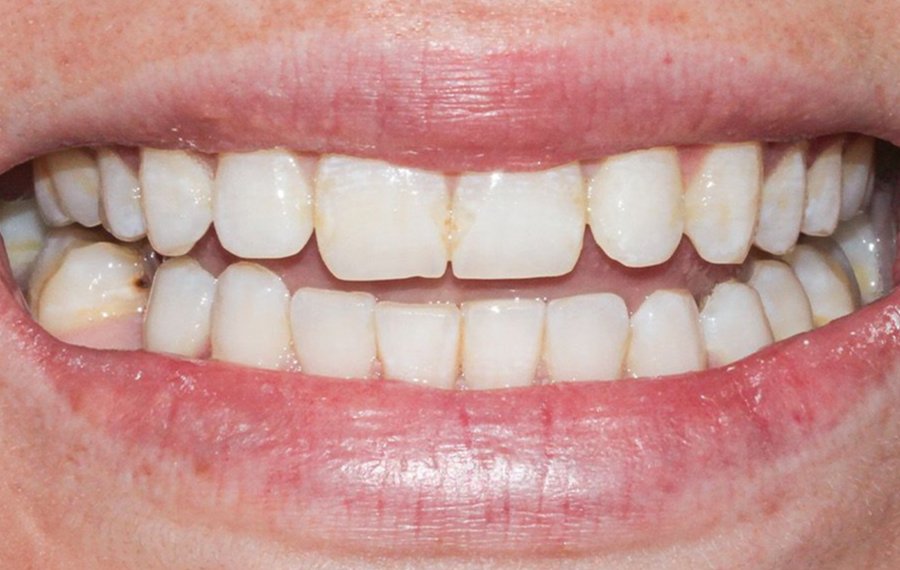 BEst Posterior Root Canal in Dubai