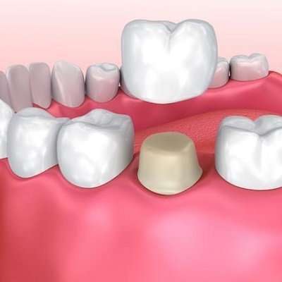 Best Ceramic Crown Dubai - Enfield Dental Clinic Dubai