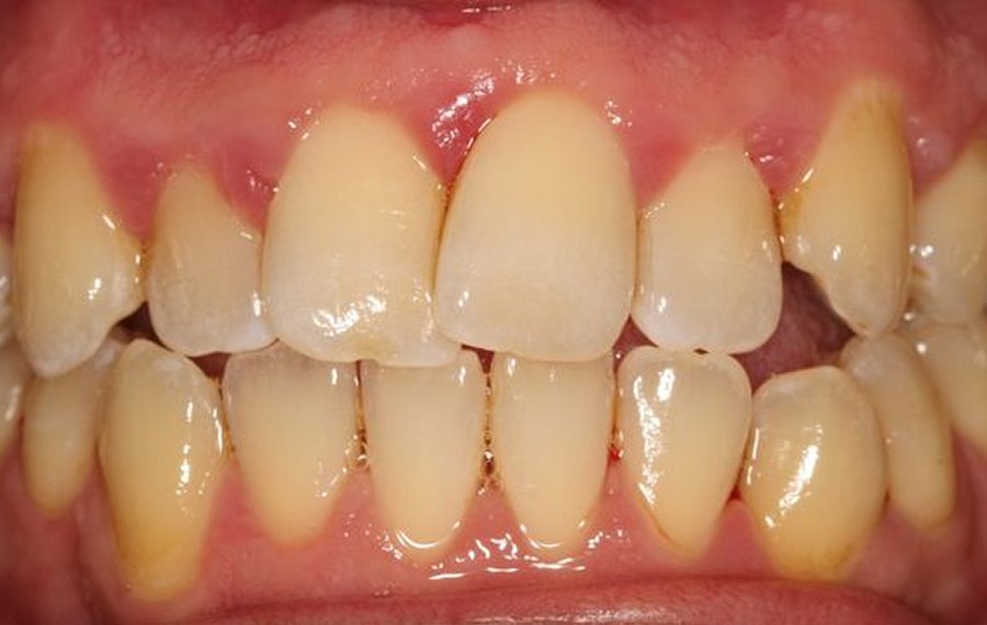Best Ceramic Crown Dubai