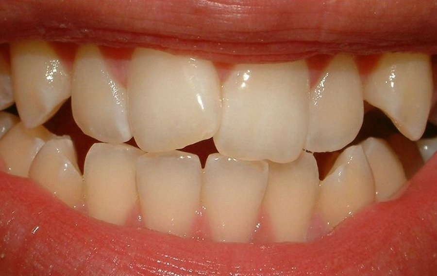 Best Ceramic Crown in Dubai