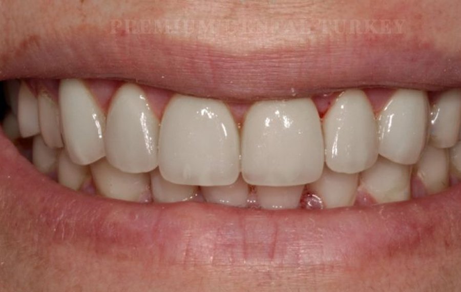 Best Composite Filling Dubai