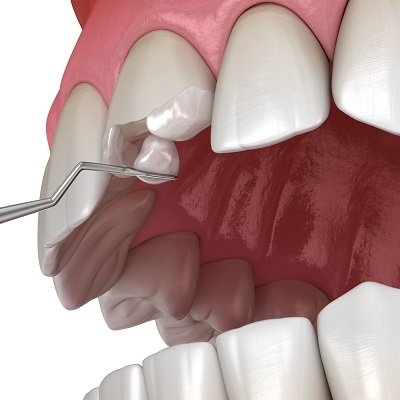 Best Composite Filling In Dubai Tooth Filling Treatment