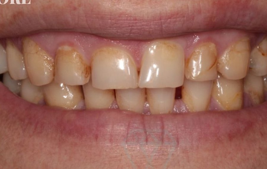 Best Composite Filling in Dubai