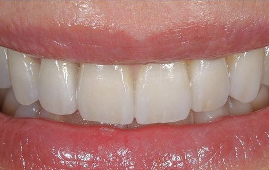 Best Composite Filling