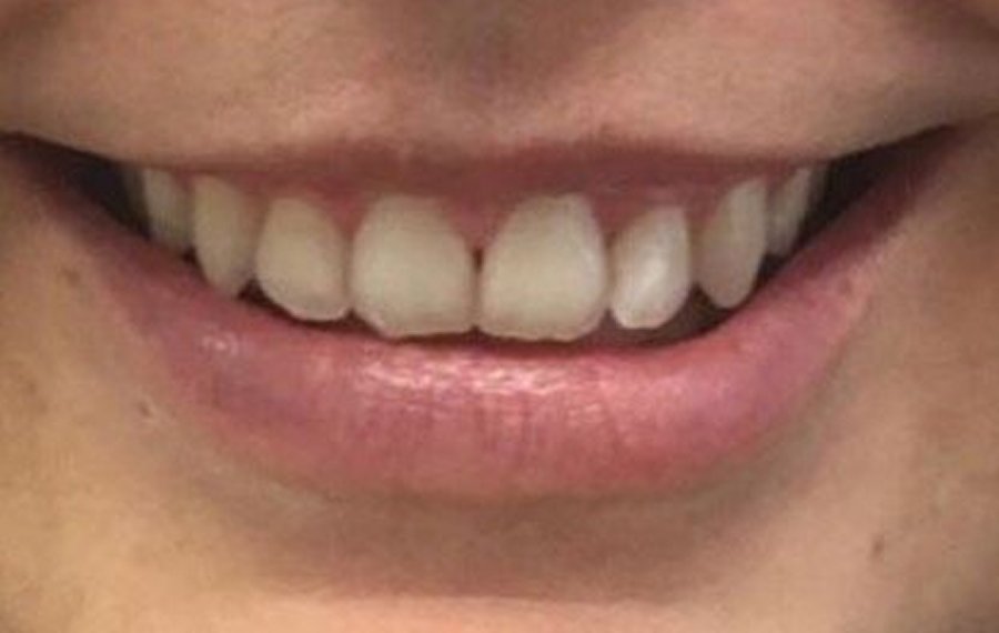 Best Composite Veneers Dubai Best Composite Veneers Dubai