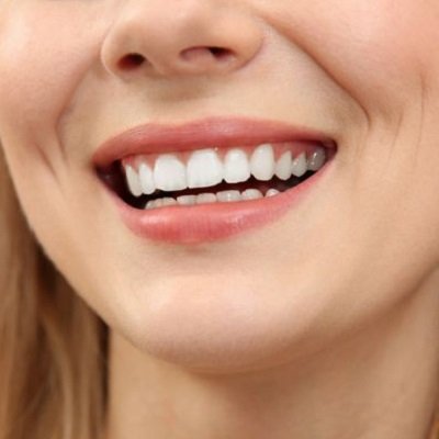 Best Composite Veneers in Dubai - Veneers Treatment