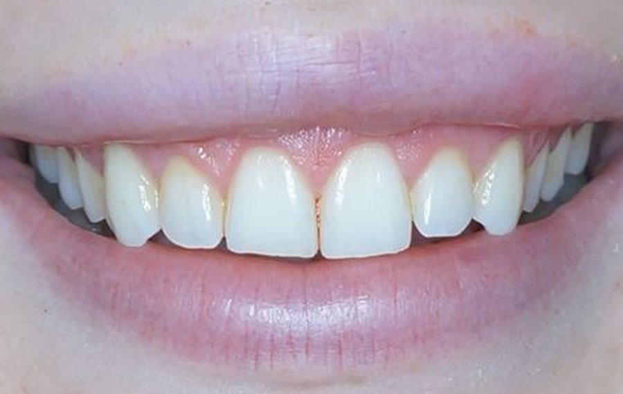 Best Composite Veneers in Dubai Best Composite Veneers in Dubai