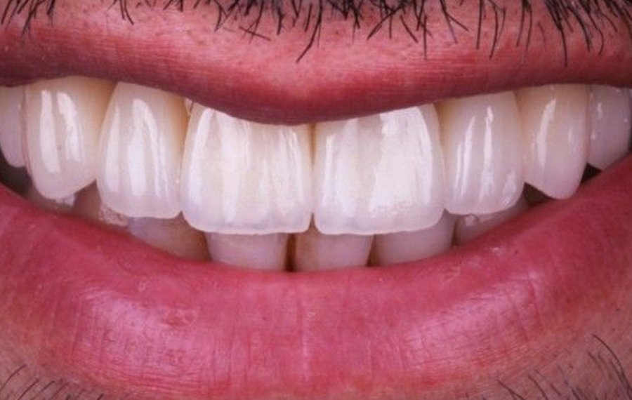 Best Crowded Teeth Treatment Dubai