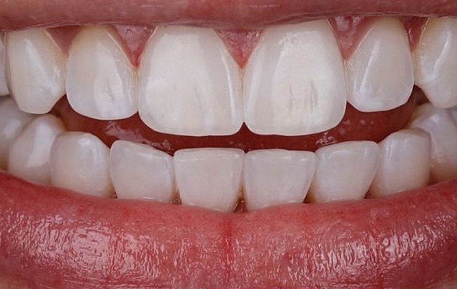 Best Crowded Teeth Treatment in Dubai