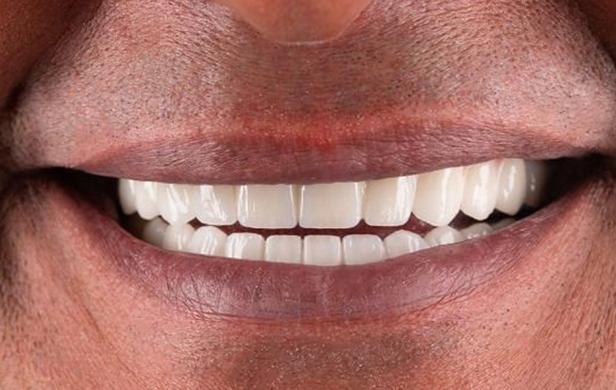 Best Dental Implant Infection in Dubai Best Dental Implant Infection in Dubai