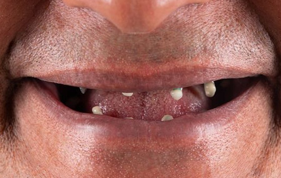 Best Dental Implant Infection Best Dental Implant Infection