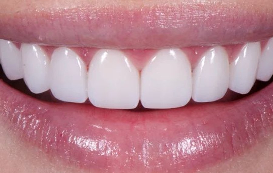 Best Dental Implants Dubai