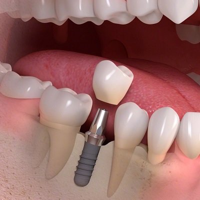 Best Dental Implants in Dubai Dental Implant Surgery