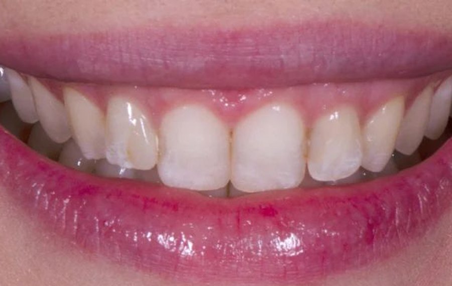 Best Dental Implants in Dubai