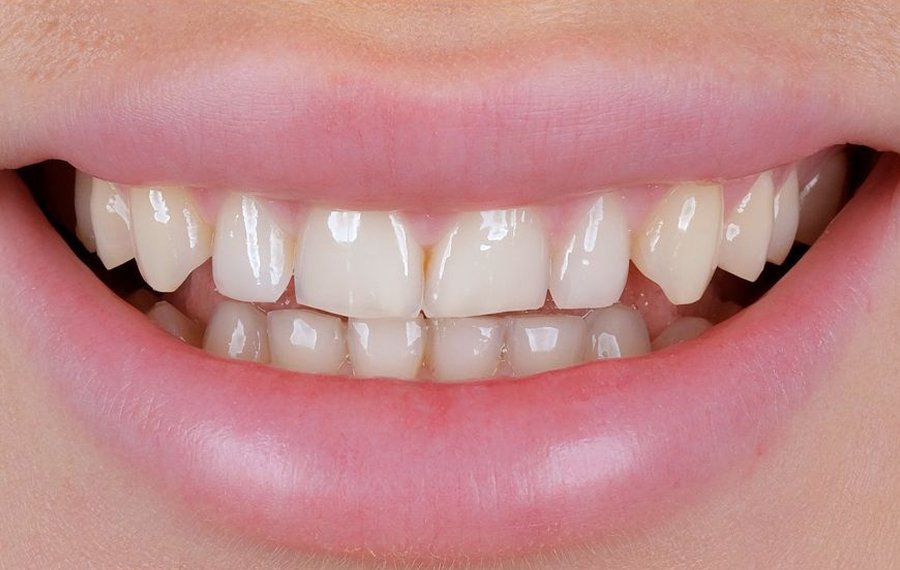 Best Dental Stains Removal in Dubai Best Dental Stains Removal in Dubai