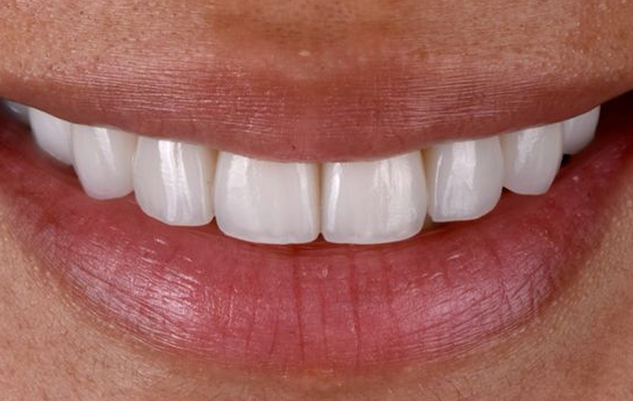 Best Gingivectomy Dubai