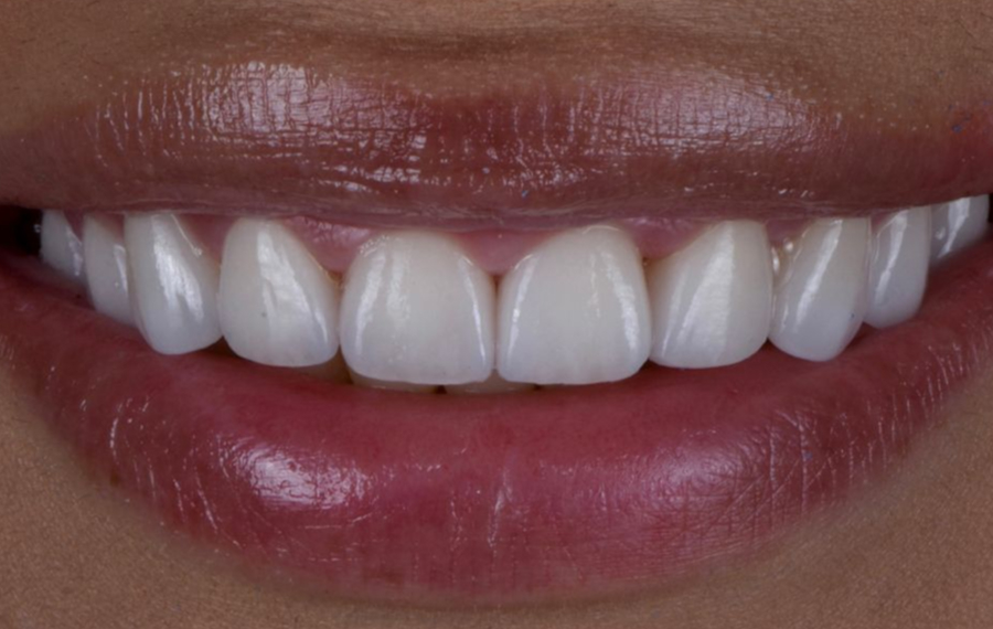 Best Gingivectomy in Dubai