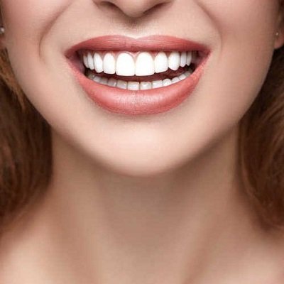 Best Hollywood Smile Design Dubai - Hollywood Smile Dubai