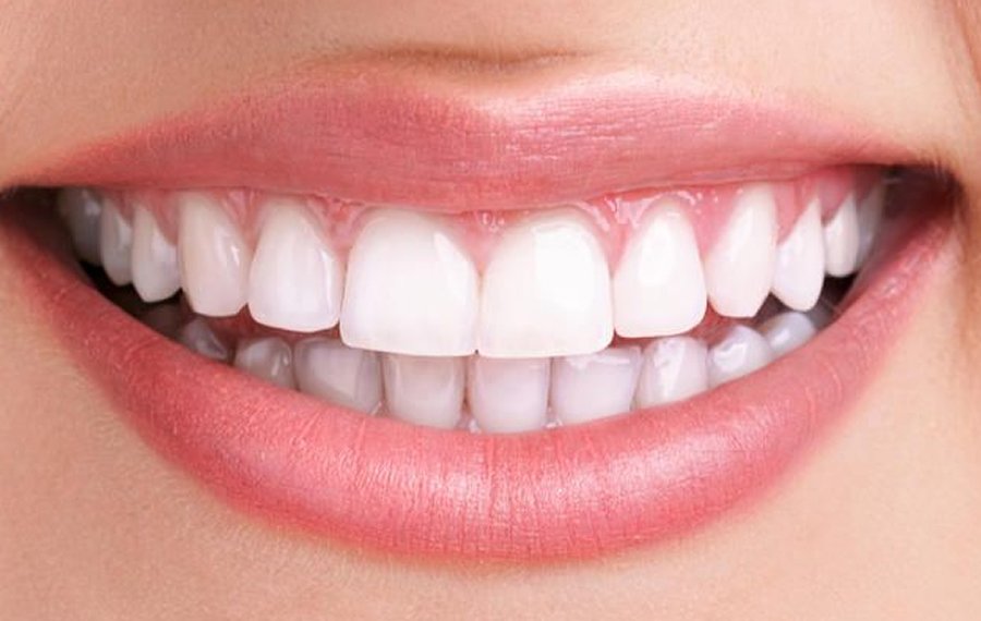 Best Hollywood Smile Design Dubai