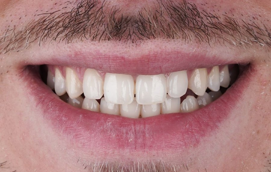 Best Hollywood Smile Design in Dubai