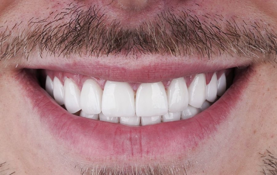 Best Hollywood Smile Design
