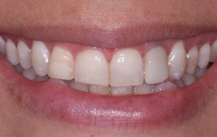 Best Lithium Disilicate Veneers Dubai