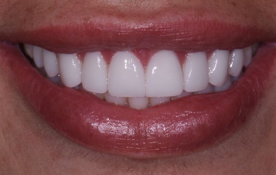 Best Lithium Disilicate Veneers