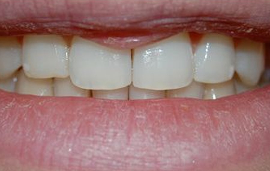 Best Mouthguards in Dubai 1