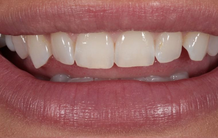 Best Nano Teeth Whitening Dubai Best Nano Teeth Whitening Dubai