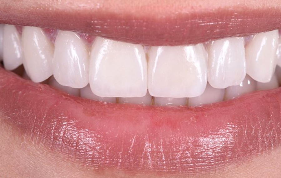Best Nano Teeth Whitening in Dubai