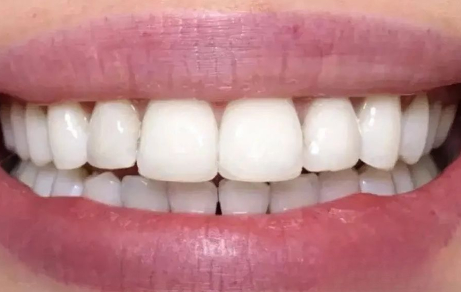 Best Nano Teeth Whitening