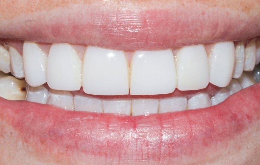 Best Posterior Root Canal