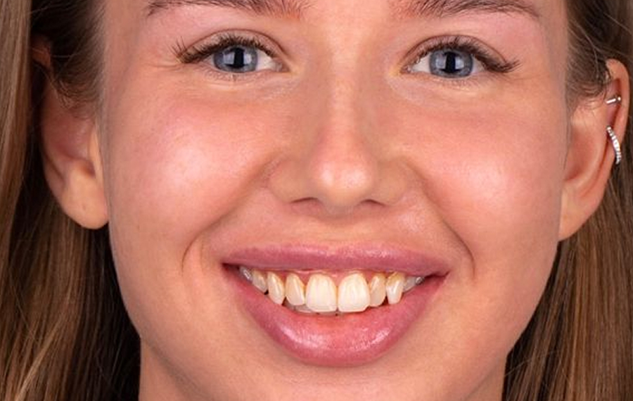 Best Root Canal Treatment Best Root Canal Treatment