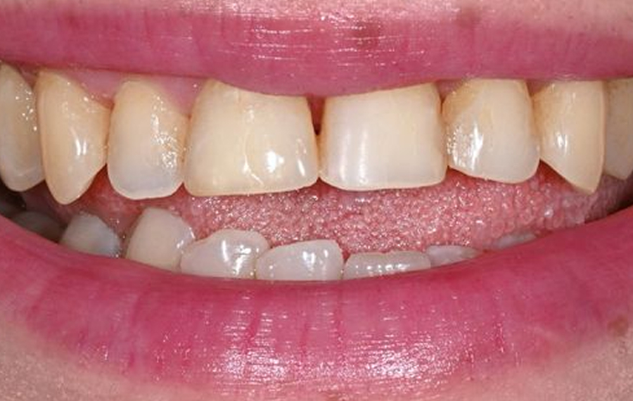 Best SMART Dental Amalgam Removal in Dubai