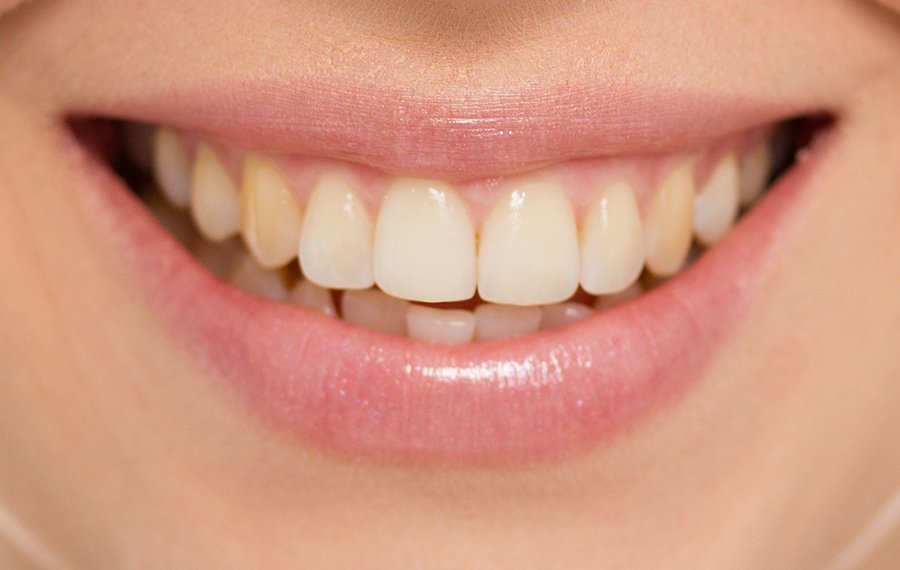 Best Teeth Cleaning Dubai Best Teeth Cleaning Dubai