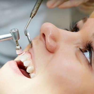 Best Teeth Polishing Scaling in Dubai Enfield Dental Clinic