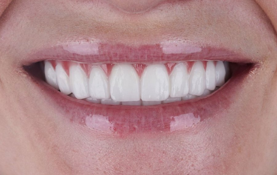 Best Teeth Polishing Scaling in Dubai