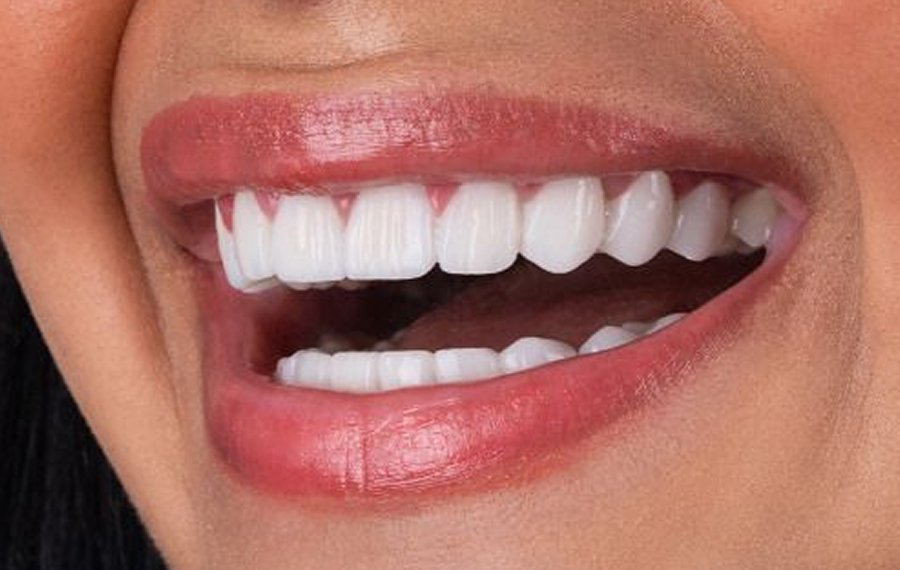 Best Teeth Polishing Scaling