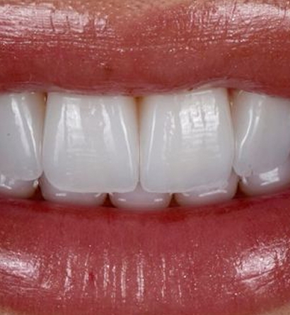 Best Teeth Retainers Dubai